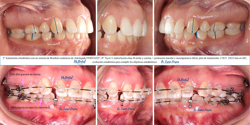 Brackets ceramicos